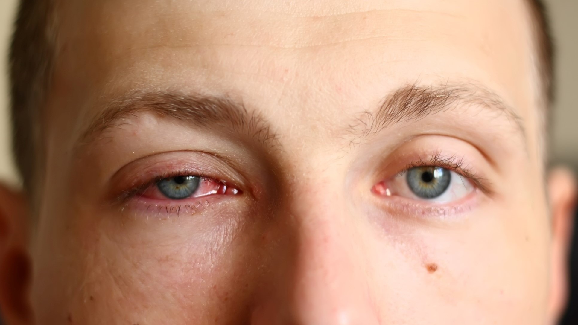 A close-up image of a young male face with a pink eye (conjunctivitis). See more in my portfolio